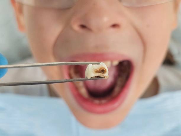 Best Emergency Treatment for Dental Infections or Abscesses in Dahlgren, VA