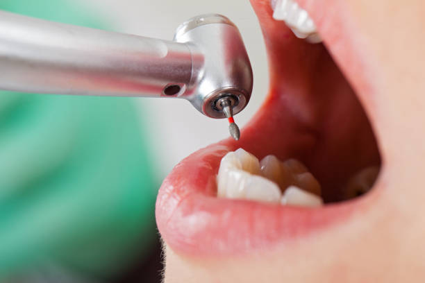 Best Emergency Treatment for Dental Infections or Abscesses in Dahlgren, VA